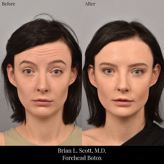 Botox for forehead lines