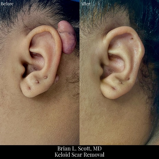 Ear Keloid Scar Removal