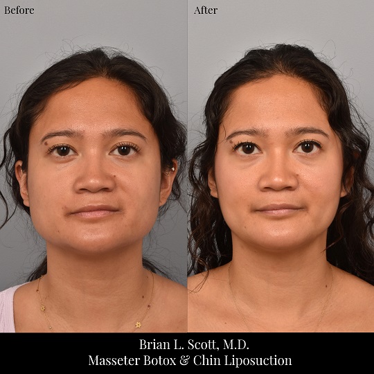 Masseter Botox