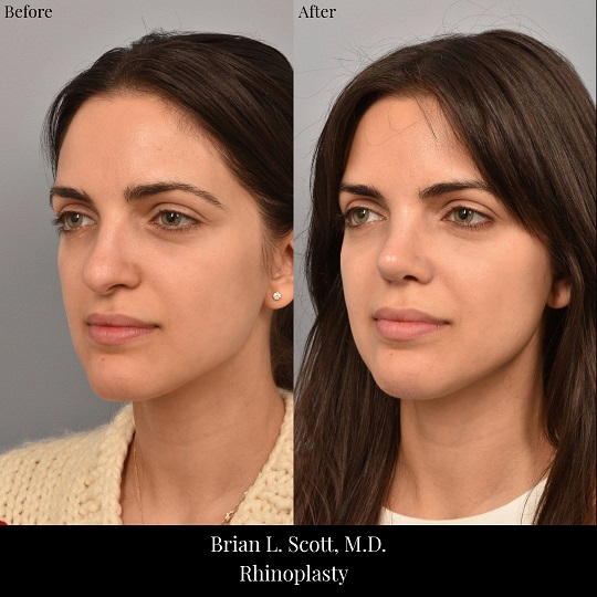 Rhinoplasty Before & After