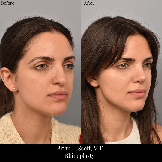 Rhinoplasty-Before-And-After-1-Oblique-Right