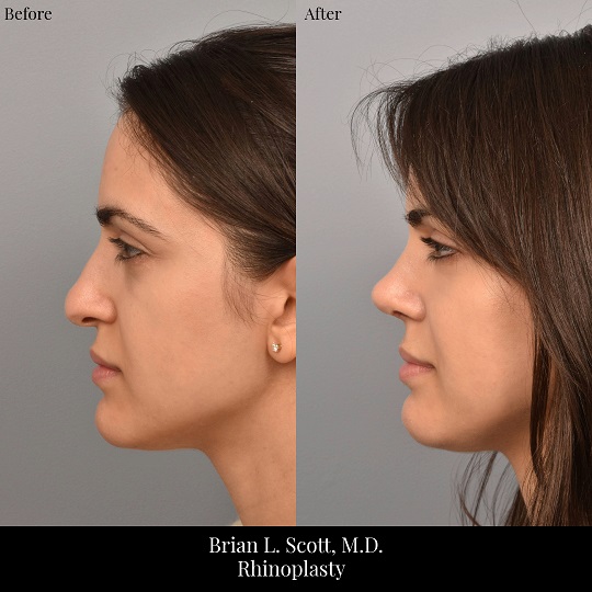 Rhinoplasty Before & After