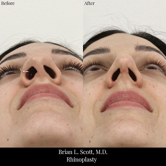 Rhinoplasty-Before-And-After-2-Base