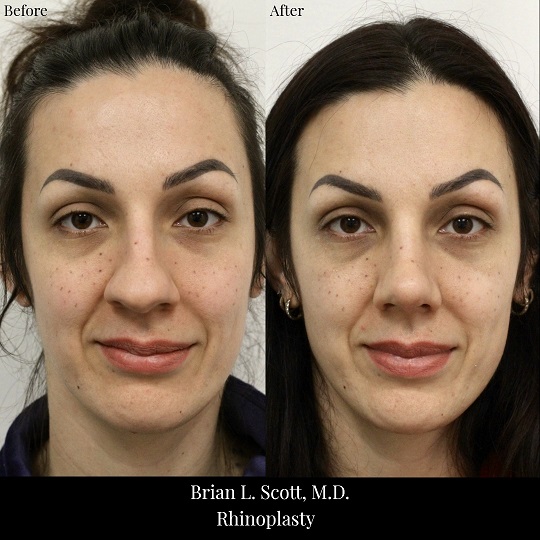 Rhinoplasty-Before-And-After-2-Front