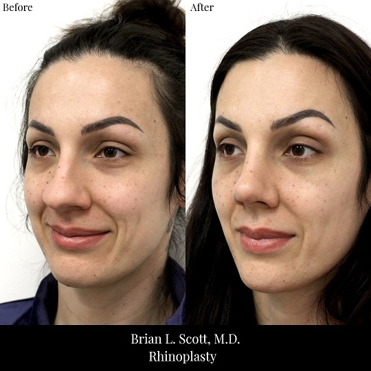 Rhinoplasty-Before-And-After-2-Oblique-Left