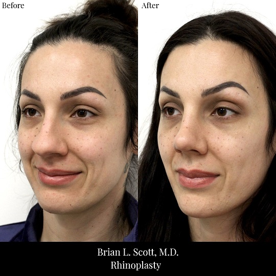 Best Rhinoplasty Bellevue