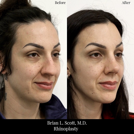 Rhinoplasty-Before-And-After-2-Oblique-Right