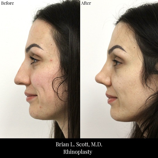 Rhinoplasty-Before-And-After-2-Side
