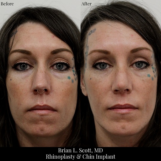 Rhinoplasty and Chin Implant