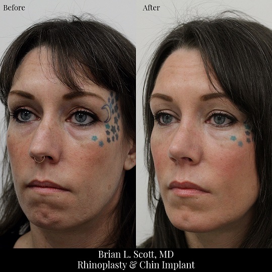 Rhinoplasty and Chin Implant