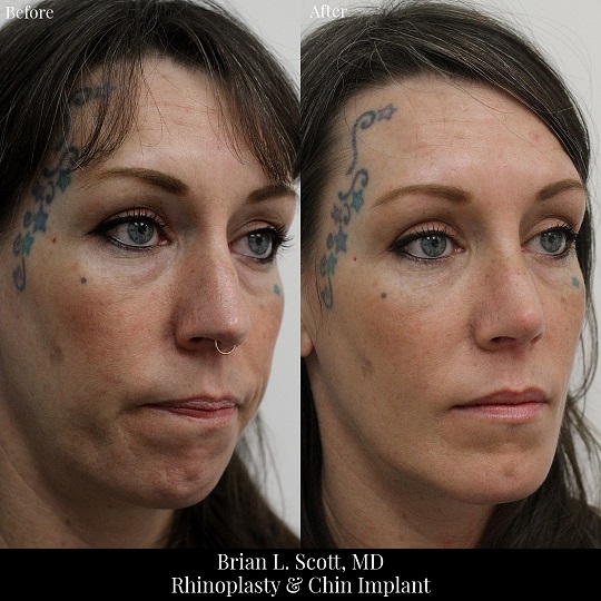 Rhinoplasty and Chin Implant