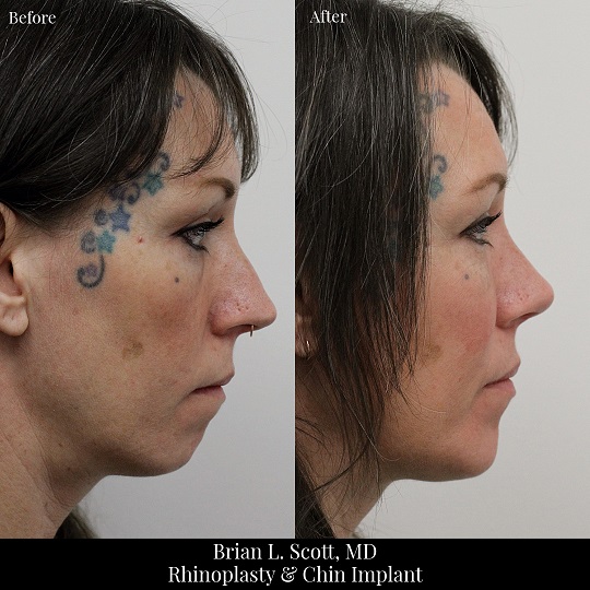 Rhinoplasty and Chin Implant