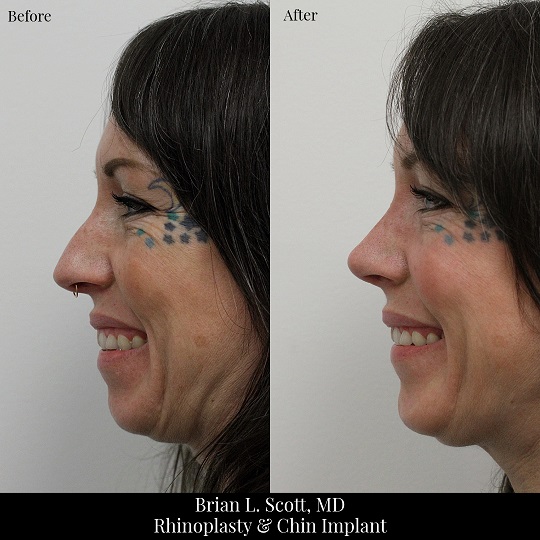 Rhinoplasty and Chin Implant