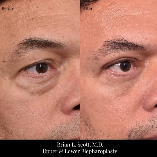 Upper and Lower Blepharoplasty Portland