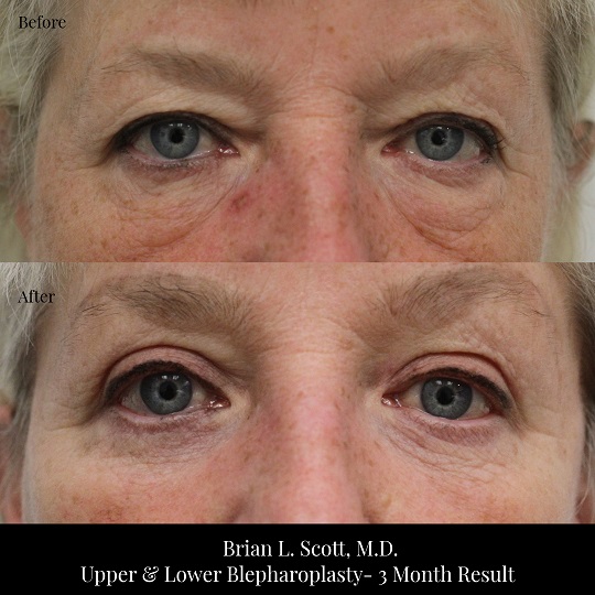 Upper and Lower Blepharoplasty Portland