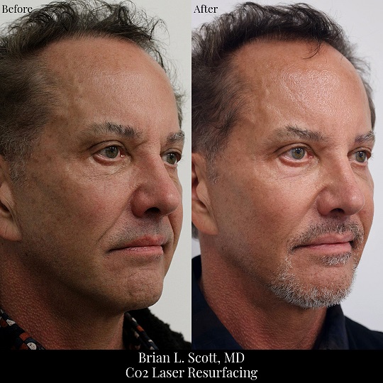 Laser Resurfacing