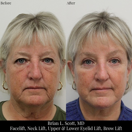 Facelift, Neck Lift, Upper Blepharoplasty, Lower Blepharoplasty, Browlift