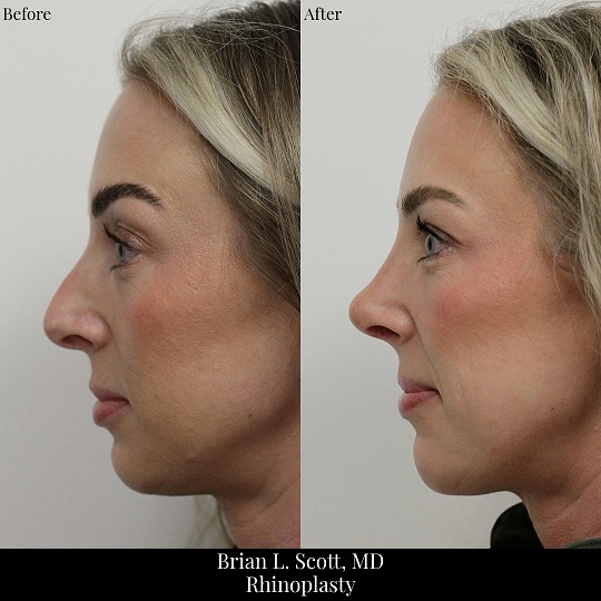 Top Rhinoplasty Portland