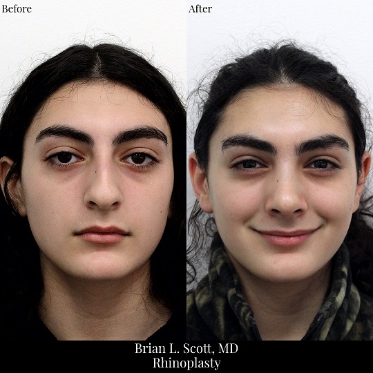 Portland Ethnic Rhinoplasty