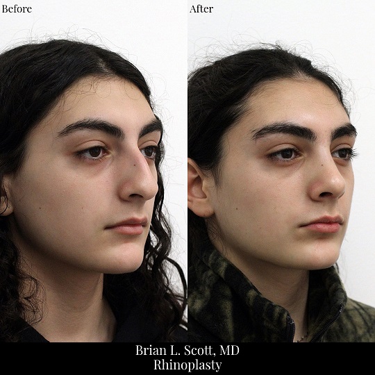 Portland Middle Eastern Rhinoplasty