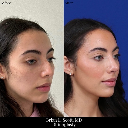 Hump Rhinoplasty