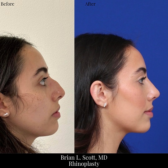 Hump Rhinoplasty