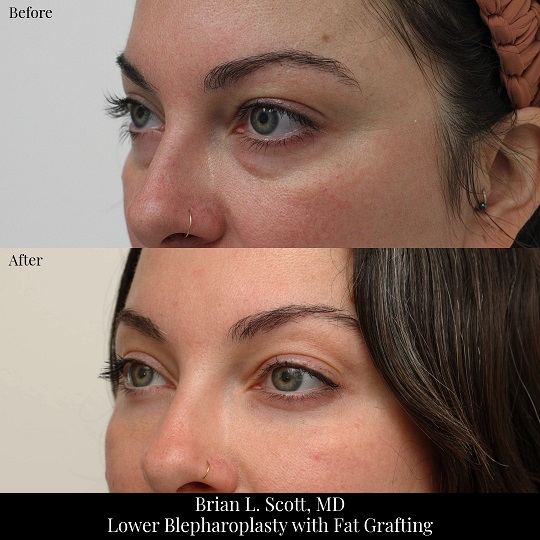 Lower-Blepharoplasty-Fat-Transfer-Portland