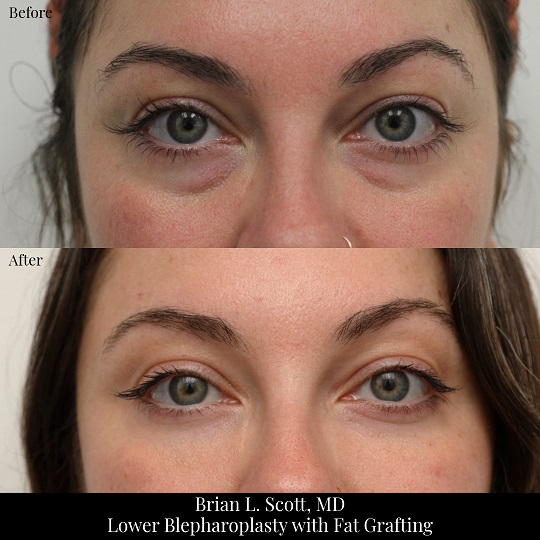 Lower-Blepharoplasty-Fat-Transfer