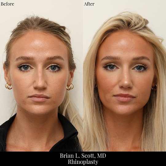 Seattle Rhinoplasty