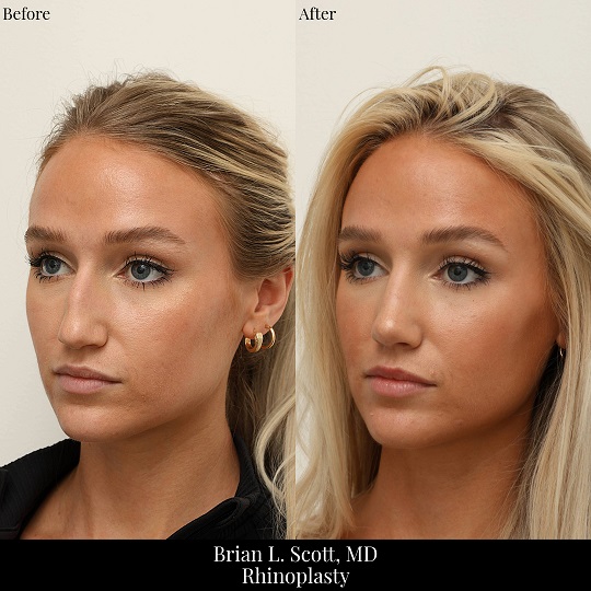 Seattle Rhinoplasty