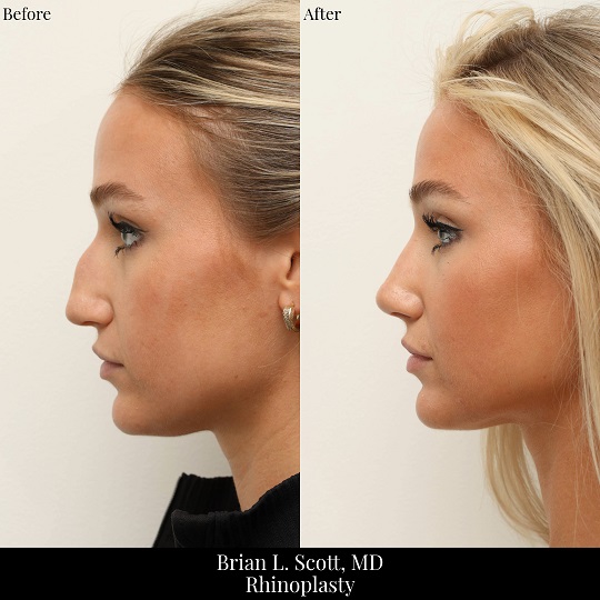 Seattle Rhinoplasty