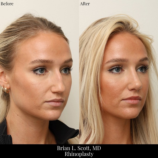 Seattle Rhinoplasty