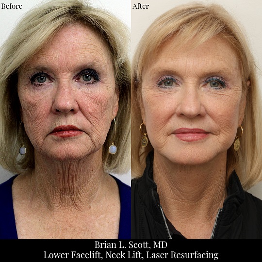 Facelift Neck Lift Laser Resurfacing Portland