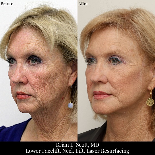 Facelift Neck Lift Laser Resurfacing Portland