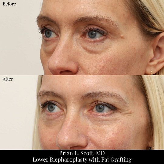 Lower Blepharoplasty with Fat Grafting