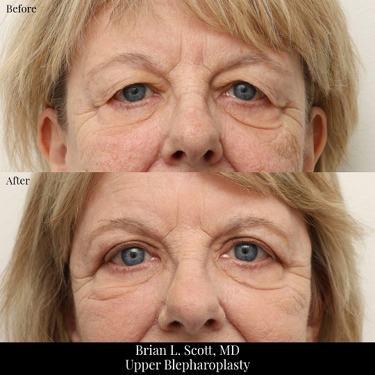 Portland Upper Blepharoplasty