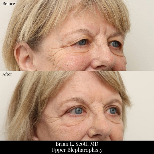 Portland Upper Blepharoplasty