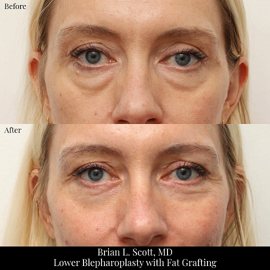 Lower Blepharoplasty with Fat Grafting