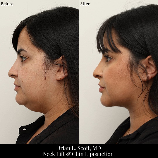 Neck Lift & Chin Liposuction