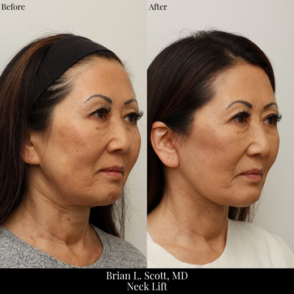 Best Neck Lift Bellevue