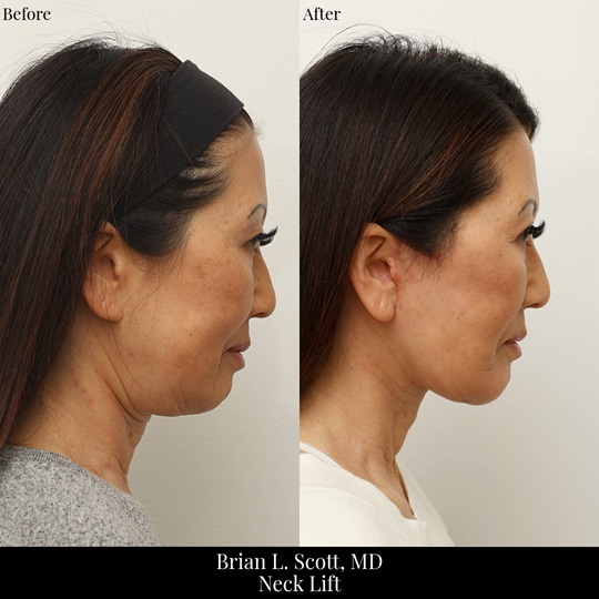 Asian Neck Lift Bellevue