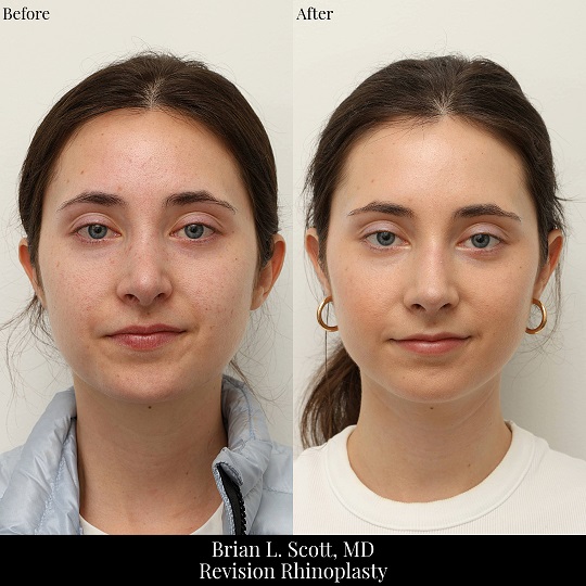 Revision Rhinoplasty Seattle