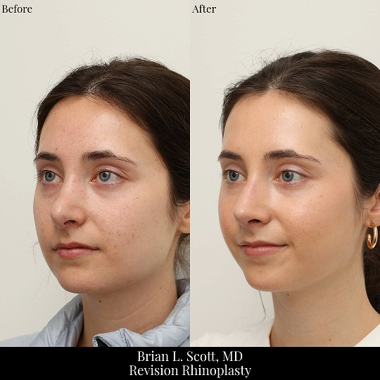 Revision Rhinoplasty Bellevue