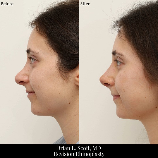 Revision Rhinoplasty Bellevue