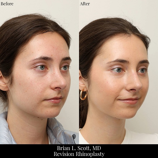 Revision Rhinoplasty Bellevue