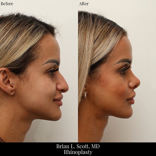 Rhinoplasty Bellevue