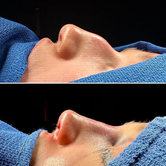 Rhinoplasty for Large Bump Seattle