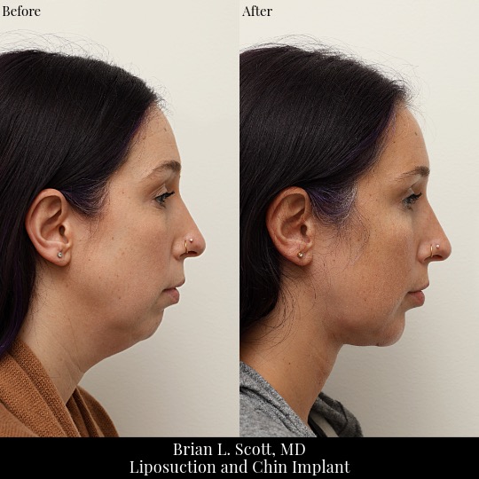 Liposuction-Chin-Implant