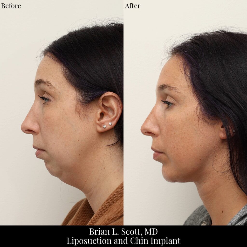 Liposuction-Chin-Implant