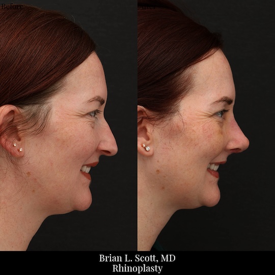 Rhinoplasty Seattle